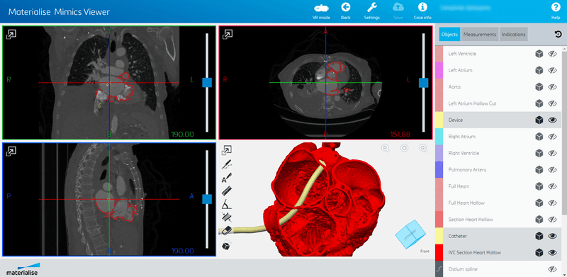 Mimics Enlight — Structural Heart Planner